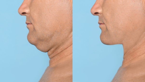 Which Non-Surgical Treatments Work Best for Jowls and Loose Skin South Ruislip?