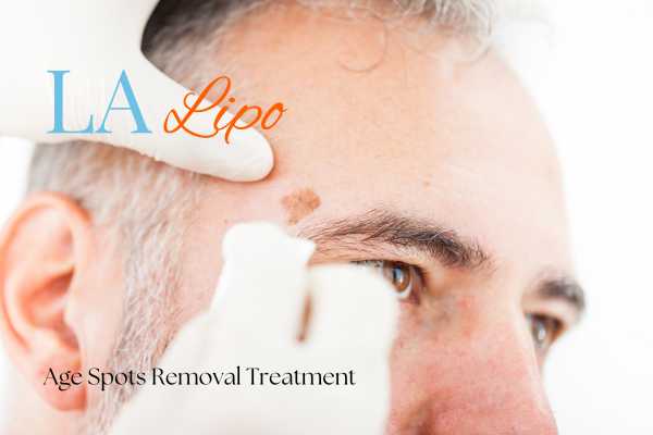 What Are the Most Effective Treatments for Age Spots South Ruislip?
