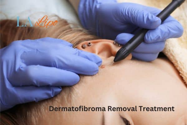 Dermatofibroma Removal Treatment South Ruislip