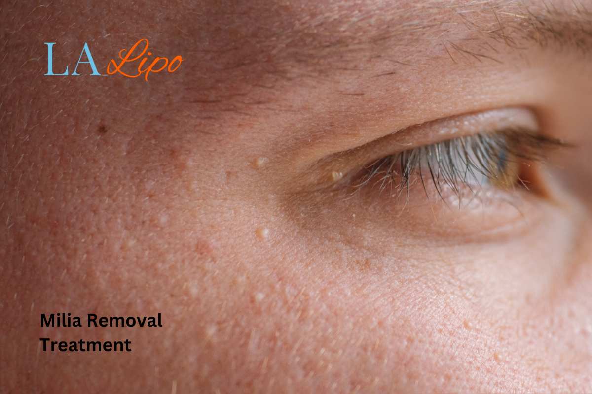 Cryopen Milia Removal: Is It the Easiest and Safest Option South Ruislip?