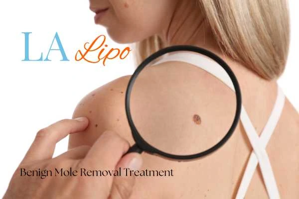 Why getting moles removed South Ruislip can boost your confidence!