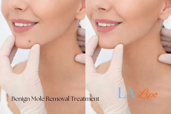 woman's before and after mole removal South Ruislip results