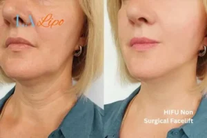hi-fu for wrinkles South Ruislip before and after results