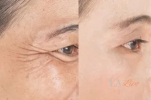 Before and after results of woman - HI-fu wrinkles reduction treatment South Ruislip