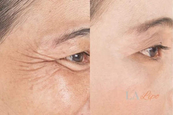 Before and after results of woman - HI-fu wrinkles reduction treatment South Ruislip