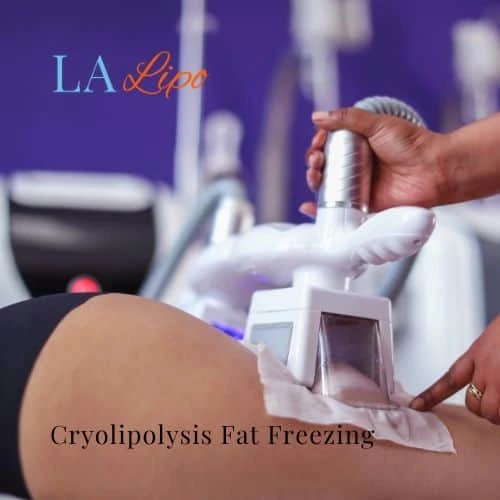 fat freezing - Cryolipolysis South Ruislip
