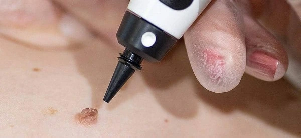 skin tag removal using cryopen South Ruislip