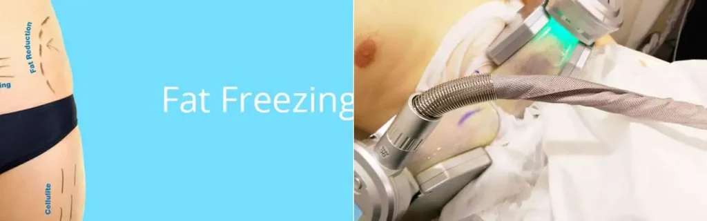 Fat freezing South Ruislip on multiple areas of the body