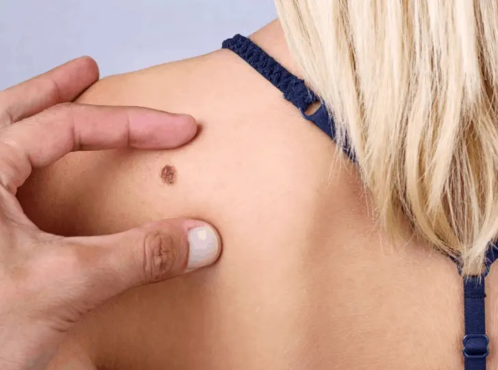 woman having mole removal South Ruislip consultation before treatment.