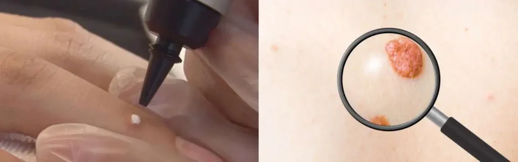 Cryopen for mole removal South Ruislip - speak to our team today!