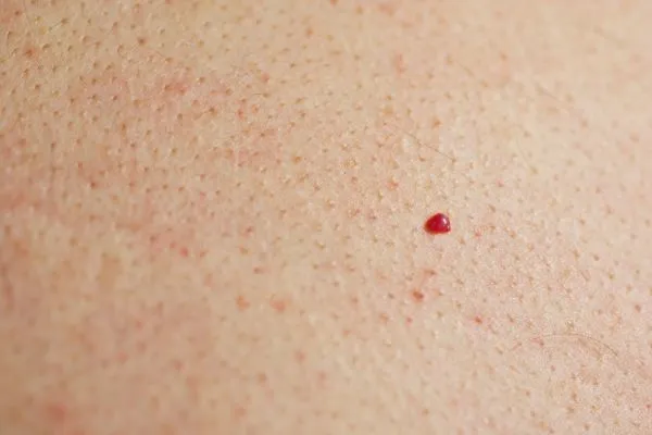 close up of a cherry angioma South Ruislip