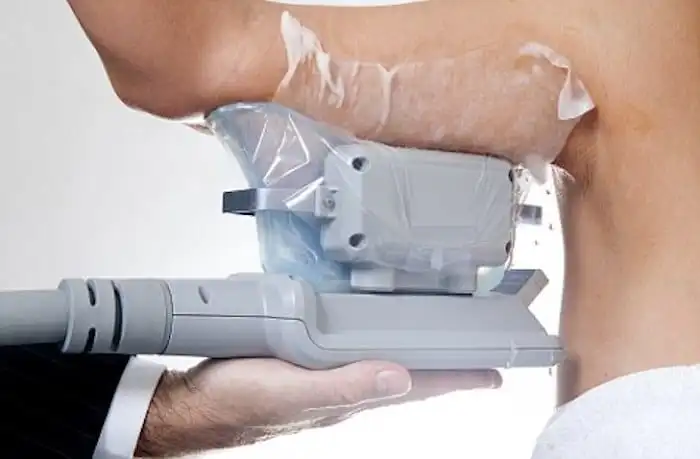 Picture of fat freezing South Ruislip on the upper arms.