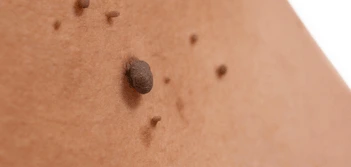 image of a skin tag South Ruislip