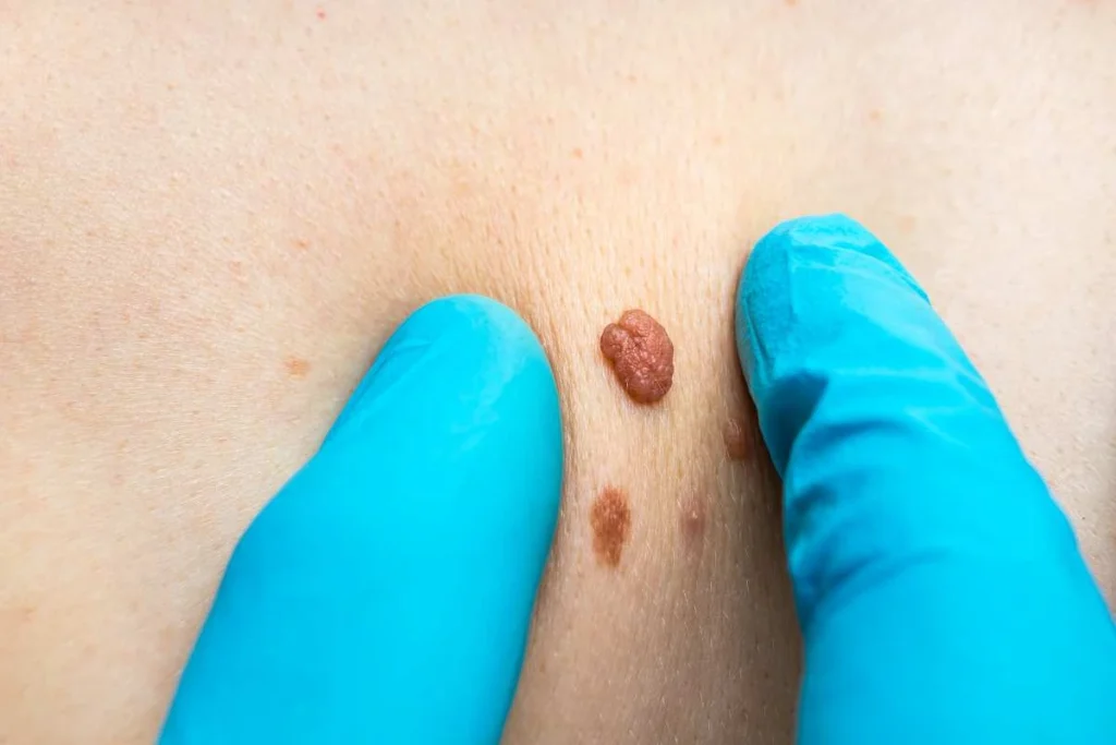 Consultant examining a skin tag South Ruislip