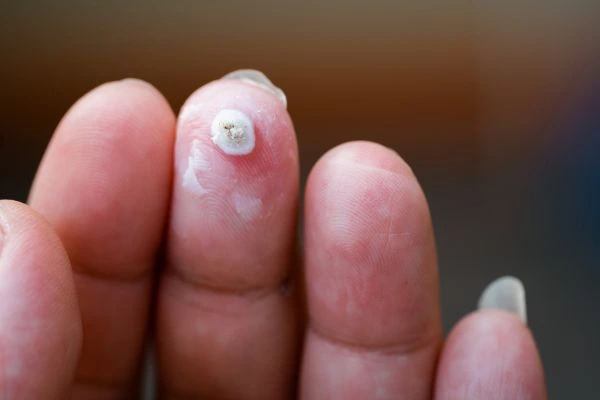 wart on person finger - cryotherapy to treat from LA LIPO South Ruislip