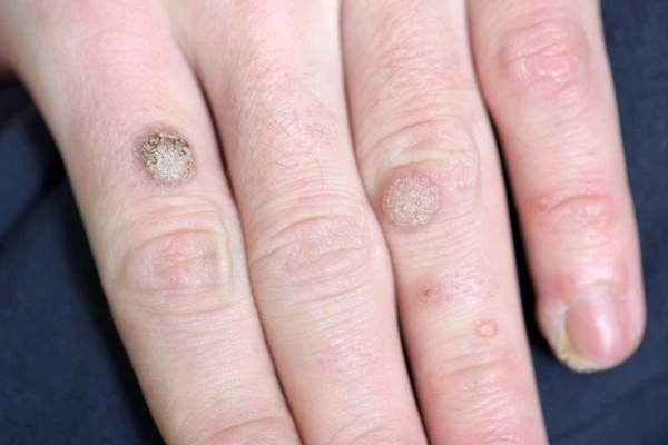 photo of warts on person hand - see wart removal South Ruislip from LA LIPO