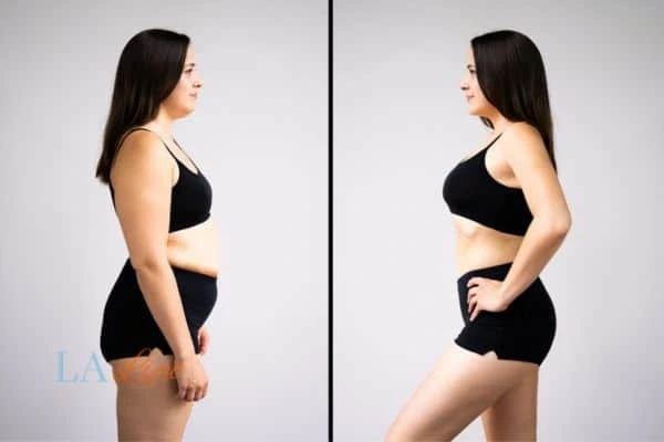 Picture of womans before and after using LA-EMS body sculpting to improve her core strength South Ruislip
