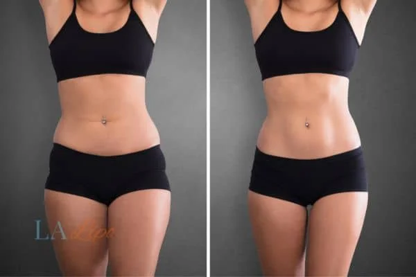 before and after results of non-surgical treatment to help a woman's body image and mental health South Ruislip