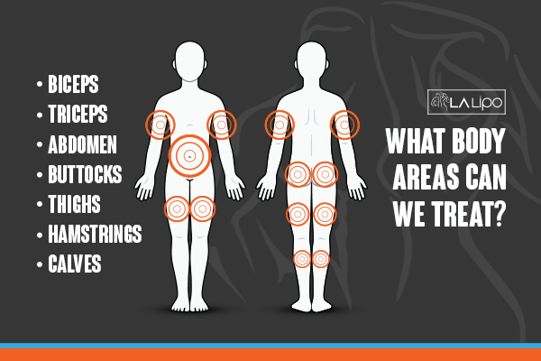 Diagram to show areas you can have LA-EMS Body Sculpting Treatment South Ruislip