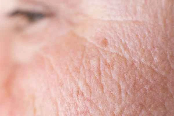 close up picture of a woman's face showing an age spot South Ruislip