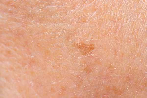 close up picture of age spots South Ruislip